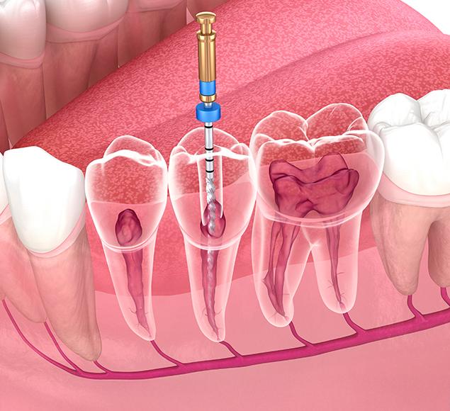 -restorative-dental-services-at-rc-dental-restorative-dentistry-rc-dental-general-family-dentist-nw-calgary-alberta Restorative Dental Services | Family Dentistry | RC Dental | NW Calgary Dentist