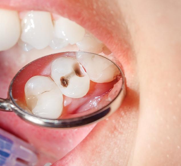 What are Dental Fillings | Family Dentistry | RC Dental | NW Calgary Dentist