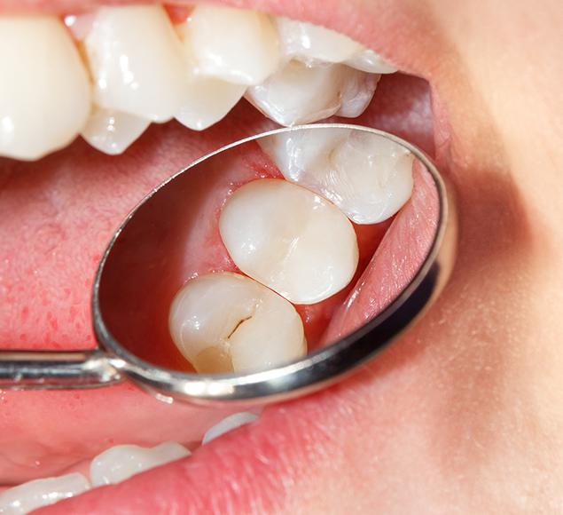 What are Dental Fillings Care | Family Dentistry | RC Dental | NW Calgary Dentist