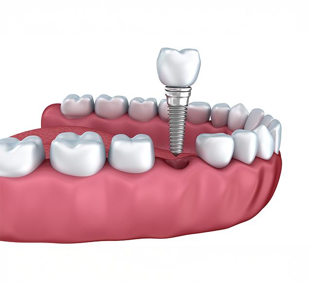 what-are-dental-implants-dental-implants-rc-dental-general-family-dentist-nw-calgary-alberta What Are Dental Implants | Family Dentistry | RC Dental | NW Calgary Dentist