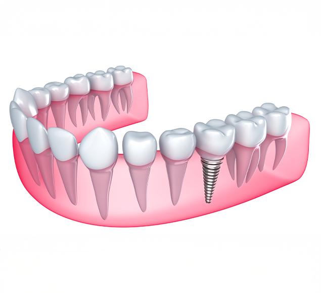 -what-are-dental-implants-dental-implants-rc-dental-general-family-dentist-nw-calgary-alberta What are Dental Implants | Family Dentistry | RC Dental | NW Calgary Dentist