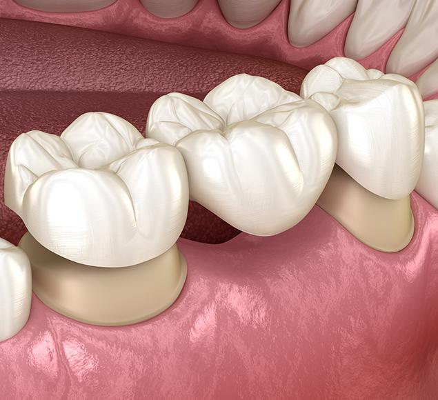 What is a Dental Bridge | Family Dentistry | RC Dental | NW Calgary Dentist