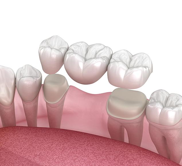 What is a Dental Bridge | Family Dentistry | RC Dental | NW Calgary Dentist
