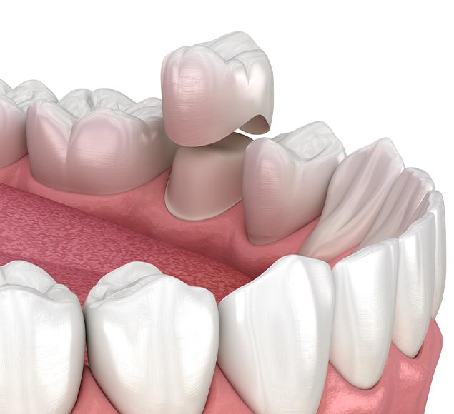 What is a Dental Crown | Family Dentistry | RC Dental | NW Calgary Dentist