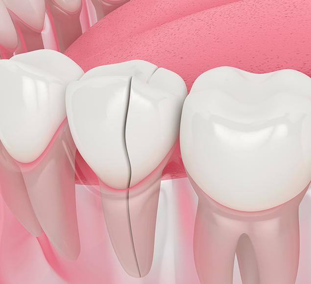 What is a Dental Crown Treatment | Family Dentistry | RC Dental | NW Calgary Dentist