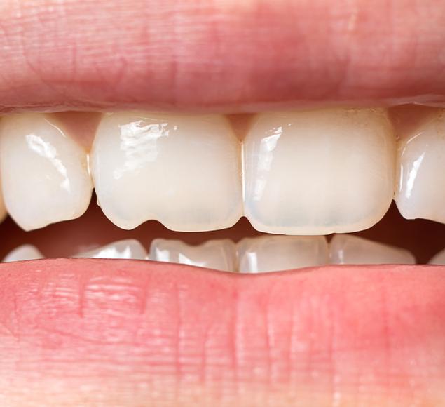 -what-is-dental-bonding-cosmetic-tooth-bonding-rc-dental-general-family-dentist-nw-calgary-alberta What is Dental Bonding | Family Dentistry | RC Dental | NW Calgary Dentist
