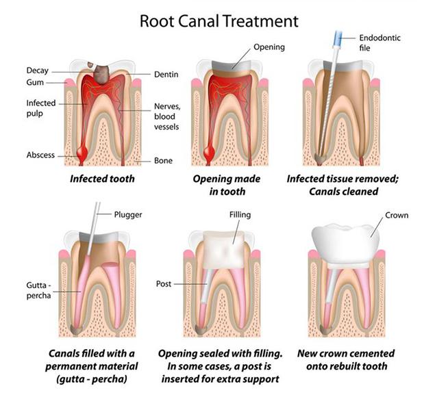 what-is-root-canal-therapy-rc-dental-general-family-dentist-nw-calgary-alberta What is Root Canal Therapy | Family Dentistry | RC Dental | NW Calgary Dentist