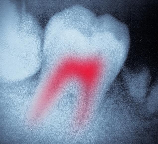 -what-is-root-canal-therapy-rc-dental-general-family-dentist-nw-calgary-alberta What is Root Canal Therapy | Family Dentistry | RC Dental | NW Calgary Dentist
