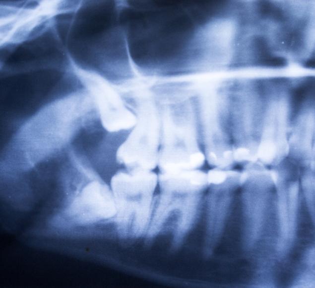 when-is-a-tooth-extraction-necessary-teeth-extraction-rc-dental-general-family-dentist-nw-calgary-alberta When is a Tooth Extraction Necessary | RC Dental | NW Calgary Dentist