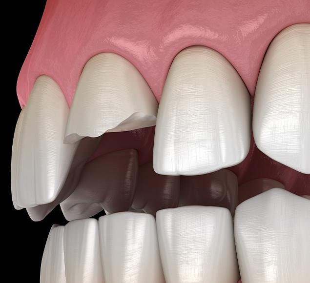 -when-is-a-tooth-extraction-necessary-teeth-extraction-rc-dental-general-family-dentist-nw-calgary-alberta When is a tooth extraction necessary | RC Dental | NW Calgary Dentist