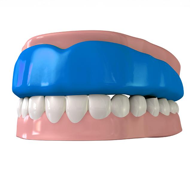 Why Consider a Custom Sports Guard | Family Dentistry | RC Dental | NW Calgary Dentist